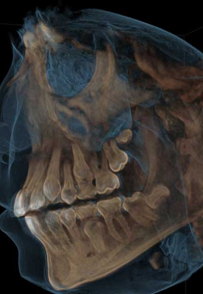 X-ray of human skull and jaw showing dental structure and teeth alignment.